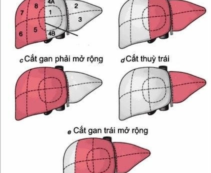 Hướng dẫn chăm sóc sau mổ cắt gan triệt căn điều trị ung thư gan